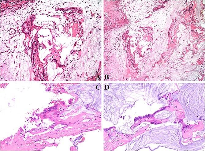 Palliative cholangiojejunostomy for refractory biliary obstruction in mucinous cholangiocarcinoma: a case report.