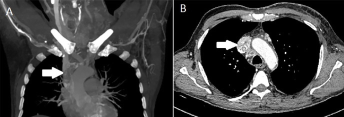 Extensive Malignant Thrombus Revealed by <sup>18</sup>F-FDG PET/CT in Patient with Papillary Thyroid Cancer.