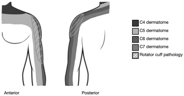Concomitant Cervical Spine Disease Worsens PROMIS Outcomes in Patients Undergoing Arthroscopic Rotator Cuff Repair.