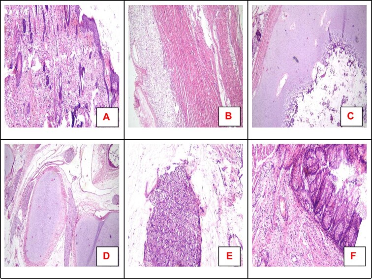 Fetus-in-fetu in an 11-day-old female infant with descriptive histopathological insights: a case report.