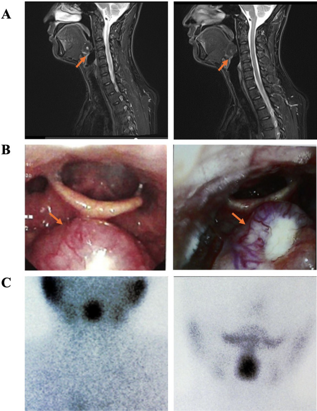 Aeromedical evaluation and successful return to flight in a military pilot with lingual thyroid: a case report and follow-up.