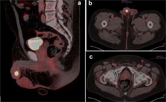 Lymphoepithelioma-like carcinoma of the distal urethra: a case report and management strategies.