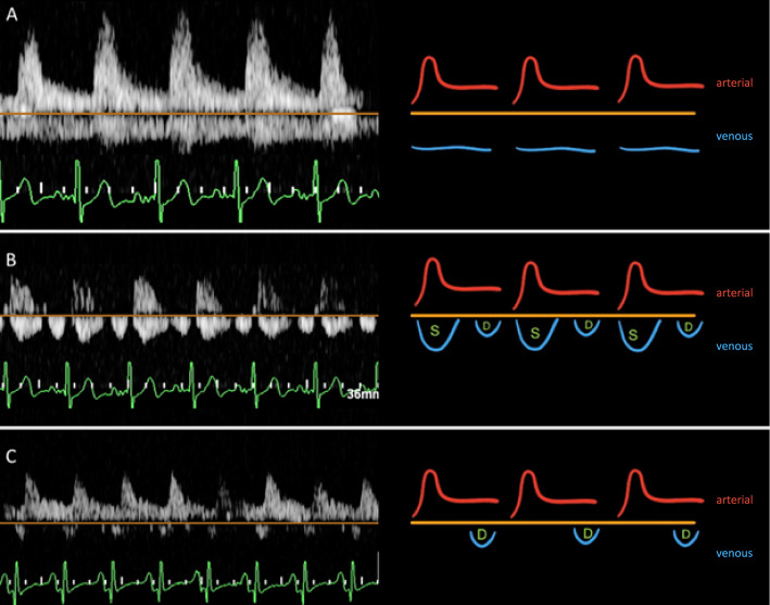 Intrarenal venous flow patterns and their association with successful fluid removal in critically ill patients: a prospective observational exploratory study.