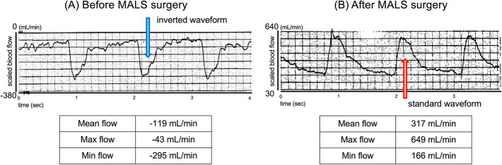 Intraoperative evaluation of median arcuate ligament syndrome using a transit-time flowmeter: a case report.