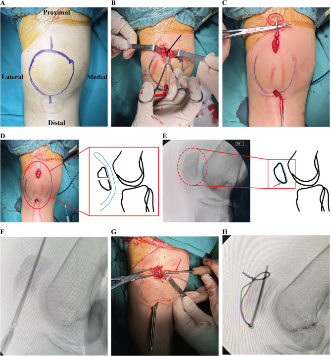 A novel approach to the minimally invasive application of a tension band for transverse patellar fractures assisted by a nice knot.