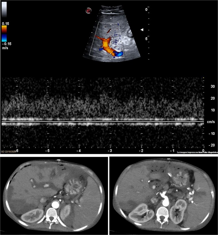 Emergency liver retransplantation for acute arterial thrombosis in a liver multi-transplanted patient: a case report.