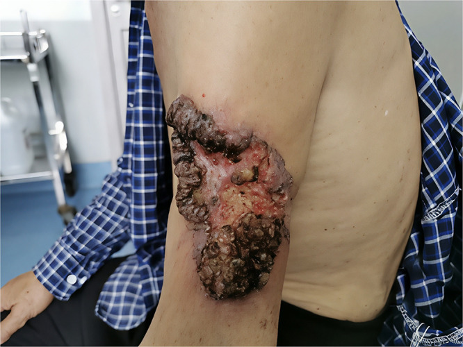 An Atypical Presentation of Basal Cell Carcinoma: A Giant Verrucous Ulcer on the Upper Arm.