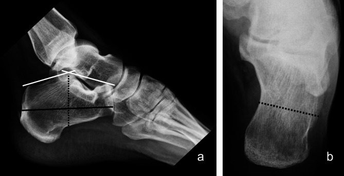 Clinical and radiologic outcomes of minimally invasive locking plate versus screw fixation for displaced intra-articular calcaneal fractures (DIACFs) via sinus tarsi approach: a comparative study.