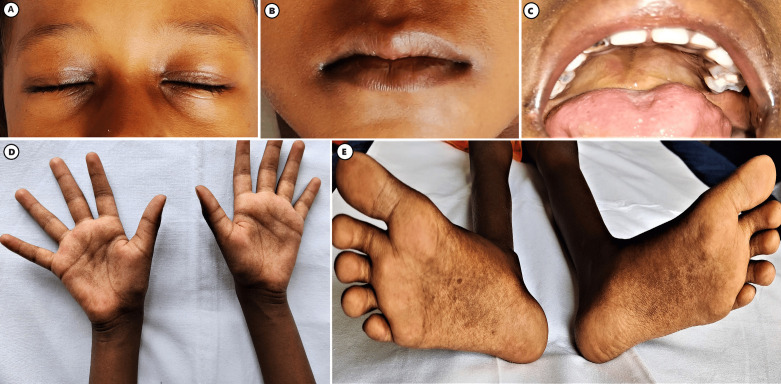 Double 'A' phenotypes with mineralocorticoid deficiency: A rare presentation of Allgrove syndrome.