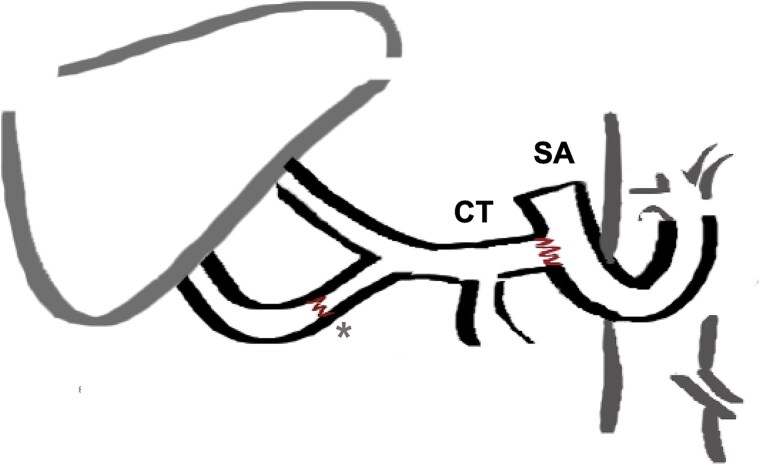 Emergency liver retransplantation for acute arterial thrombosis in a liver multi-transplanted patient: a case report.