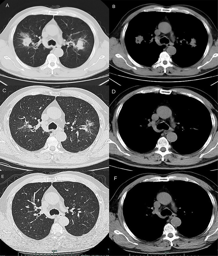 Metagenomic Next-Generation Sequencing Reveals <i>Tannerella forsythia</i> in Lung Abscesses: A Retrospective Case Series Linking Smoking, Oral Health, and Diagnostic Challenges.