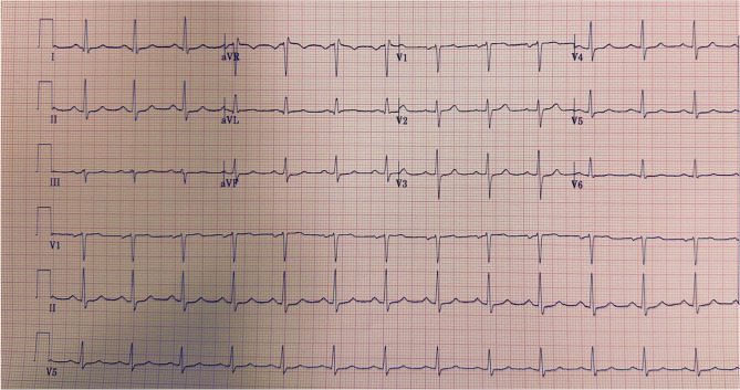 Serial electrical cardioversion for refractory atrial fibrillation with rapid ventricular response post ablation.