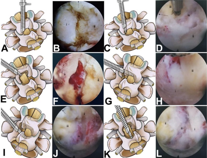 Efficacy and Safety of Unilateral Interlaminar Endoscopic Decompression for Lumbar Spinal Stenosis: A Retrospective Study of 176 Cases With a 3-6 Year Follow-Up.