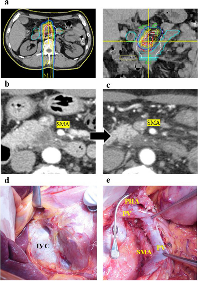 Safety and pathological impact of resection after high-dose PBT for locally advanced pancreatic cancer.