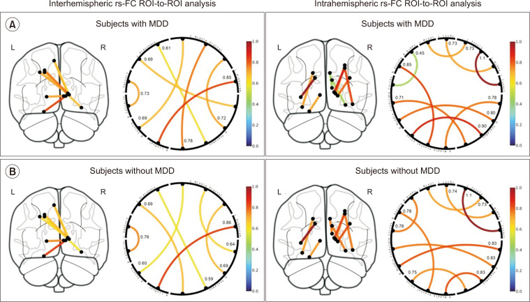 Major depressive disorder in fibromyalgia: novel insights from resting-state functional connectivity analysis.