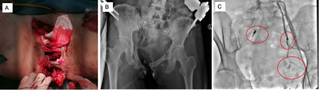 Clinical characteristics and mortality risk factors in polytrauma patients with pelvic fractures: a retrospective study based on an integrated multidisciplinary treatment approach.
