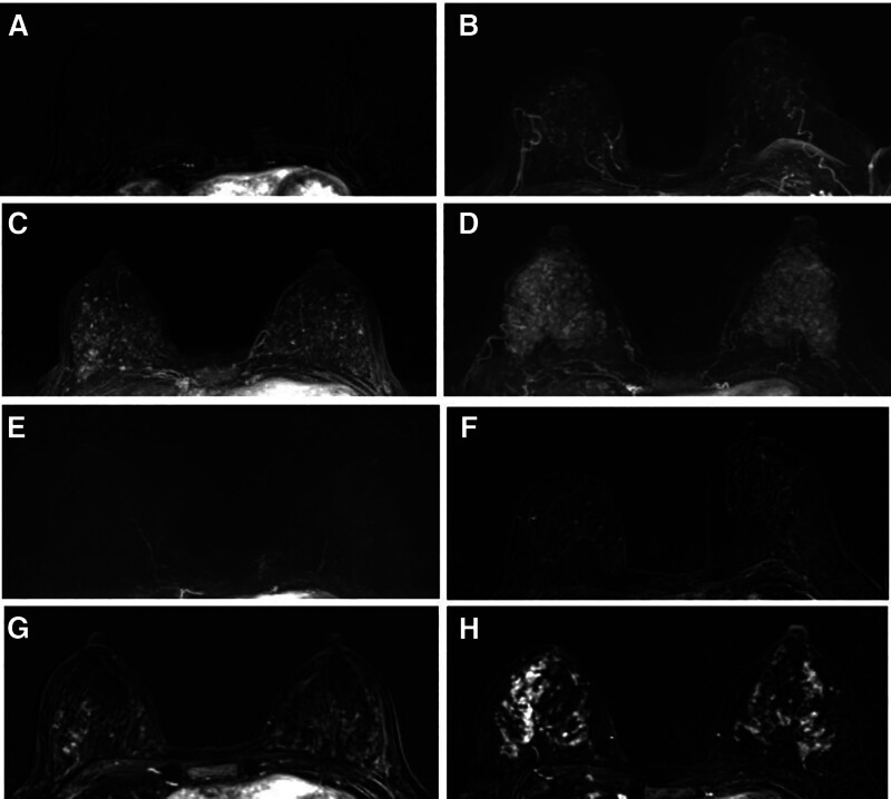 Background parenchymal enhancement in MR and breast mammographic density in full-field digital mammography: Correlations with breast cancer risk.
