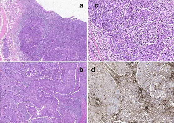 Lymphoepithelioma-like carcinoma of the distal urethra: a case report and management strategies.