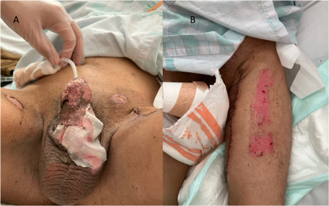 Genital burns caused by cell phone combustion following a motorcycle accident: a case report.