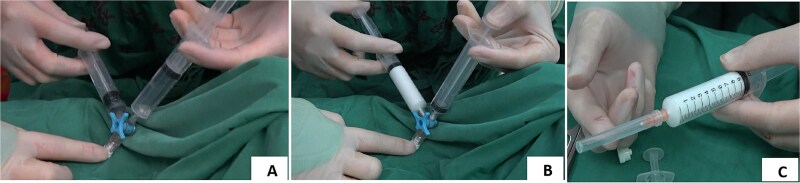 Polidocanol foam injection sclerotherapy in patients with mixed hemorrhoids with severe anemia: a case report.