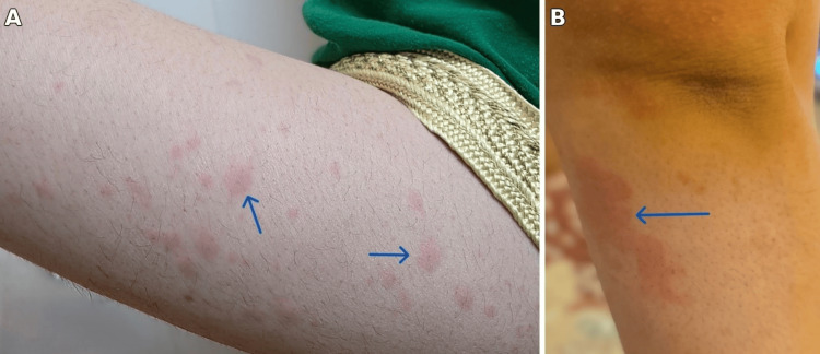 Adult-Onset Still's Disease Presenting as Antibiotic-Refractory Sepsis.