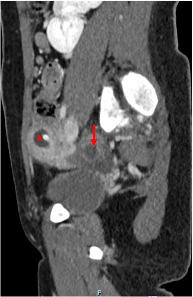 Mayer-Rokitansky-Küster-Hauser syndrome complicated by hematometra and hematosalpinx treated with laparoscopic uterine drain placement: a case report.
