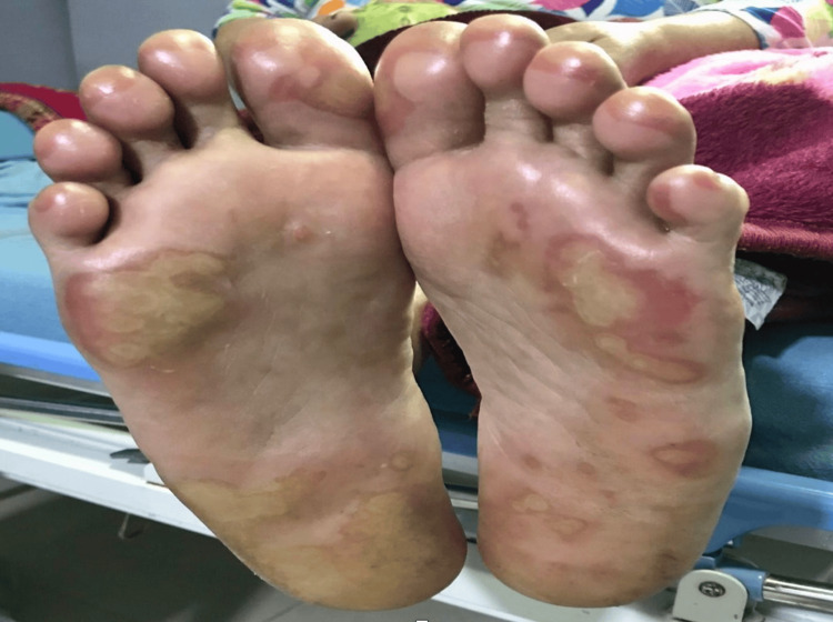 Unmasking the Masked: A Case Report of Atypical Methotrexate Toxicity Leading to Severe Bone Marrow Suppression.