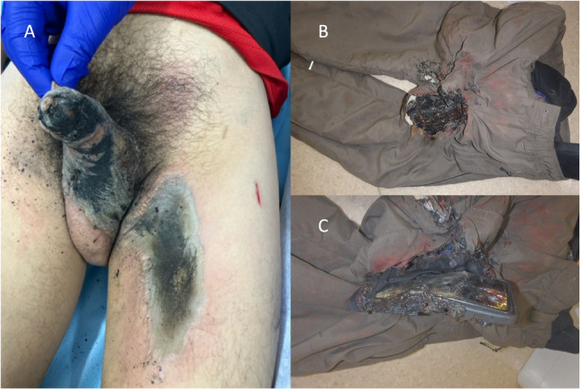 Genital burns caused by cell phone combustion following a motorcycle accident: a case report.