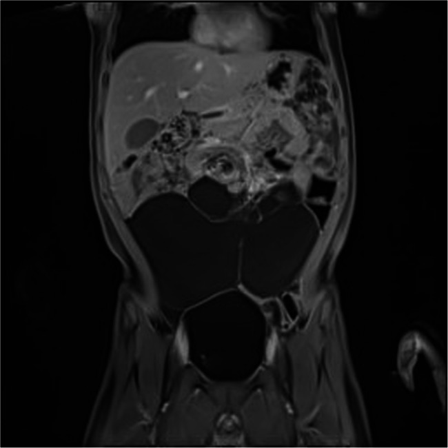 Laparoscopic management of giant abdominal cystic lymphangiomas: experience from the queen Fabiola children's university hospital.