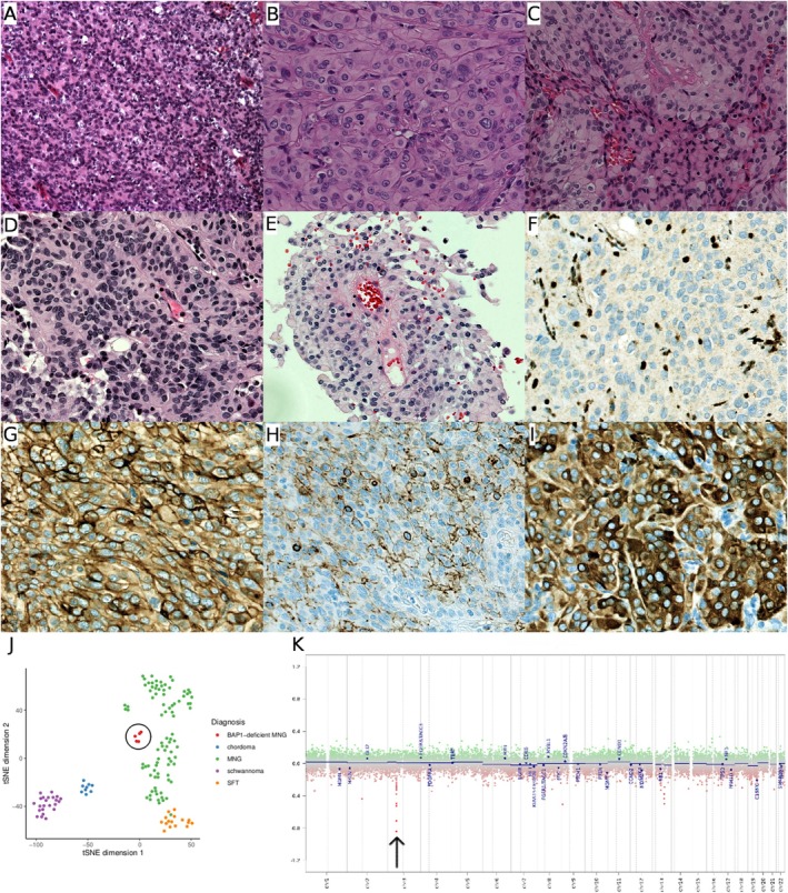 A Specific Methylation Class Identifies BAP1-Deficient Meningiomas, Including Meningeal Tumours With Poorly Differentiated Nonrhabdoid Histology.