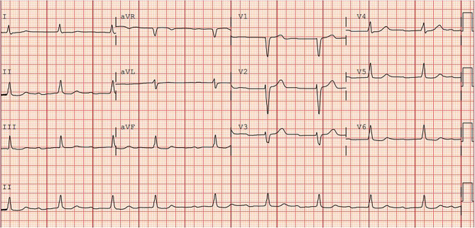 Peculiar conduction.