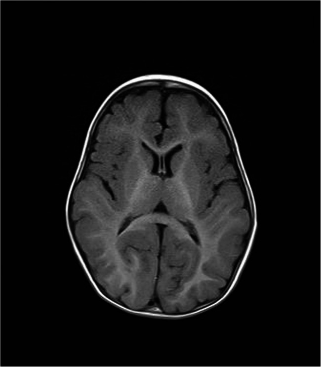 Wiedemann-Steiner syndrome: description of genetic profiles and clinical phenotypes of 10 Korean pediatric patients.