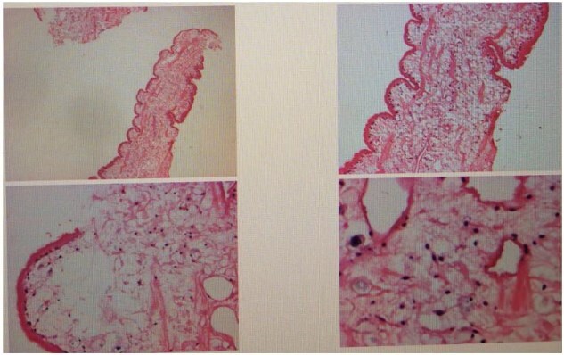 A case report of inguinal hernia combined with sparganum infestation.