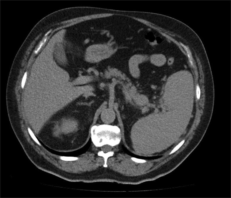 Delayed pancreatic metastasis from renal cell carcinoma managed with pazopanib and stereotactic ablative body radiotherapy.