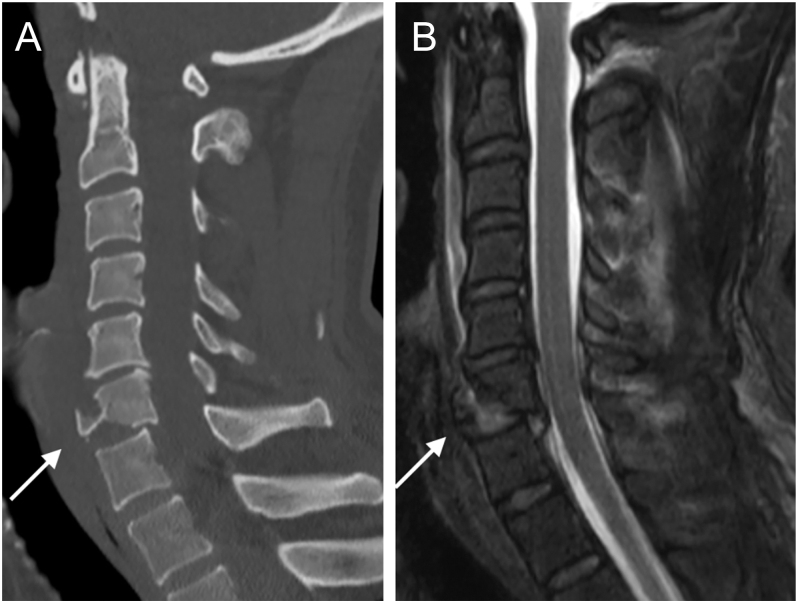 Flexion teardrop fracture of the cervical spine: a narrative review.