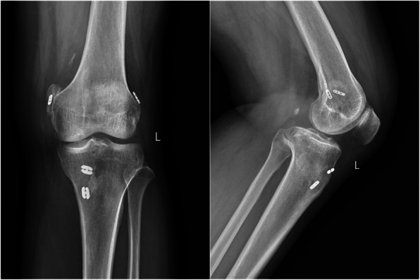 Septic arthritis or adult-onset still's disease: analyzing the causes of recurrent fever after arthroscopic combined anterior cruciate ligament and posterior cruciate ligament reconstruction: a case report.