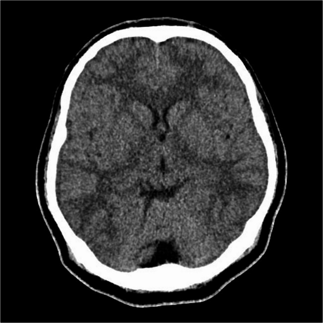 Isolated oculomotor nerve palsy in Neisseria meningitidis meningitis: a case report and literature review.