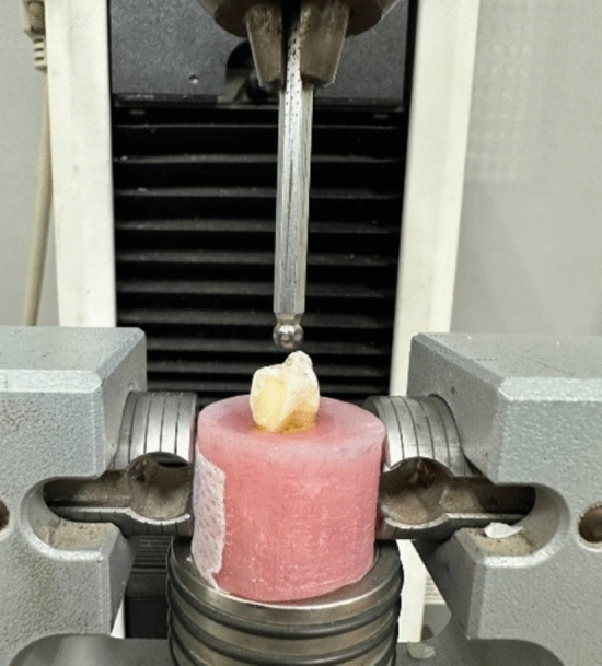 Effect of different cavity designs and CAD/CAM blocks on fracture resistance of maxillary premolars with MOD cavities.