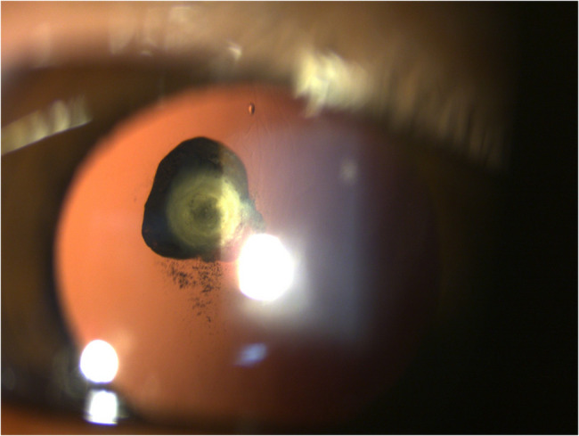 Posterior polar cataract combined with vitreous cysts.