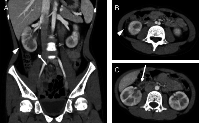 Renal and gastrointestinal complications following tosufloxacin therapy for suspected mycoplasma infection in a 10-year-old child.