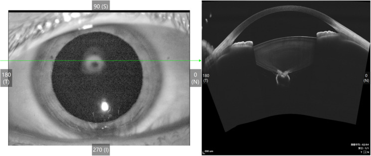 Posterior polar cataract combined with vitreous cysts.