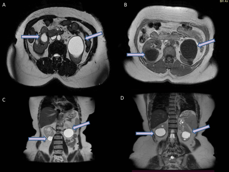 An Elusive Diagnosis of Autosomal Dominant Alport Syndrome: Genomic Sequencing Is a Game Changer.