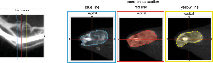 Minimal invasive open tibial fracture model in mice.