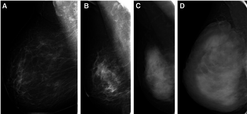 Background parenchymal enhancement in MR and breast mammographic density in full-field digital mammography: Correlations with breast cancer risk.