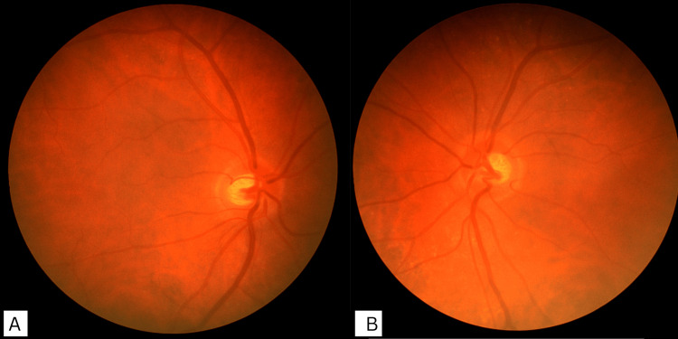 The Role of Exenatide, a Glucagon-Like Peptide-1 (GLP-1) Receptor Agonist, in Idiopathic Intracranial Hypertension and Polycystic Ovary Syndrome: A Case Report.