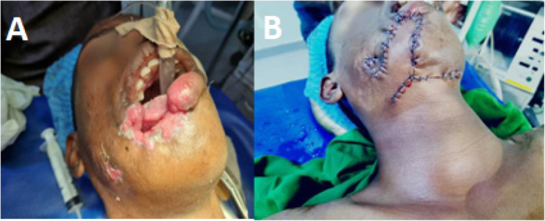 Plastic surgery interventions for war-related injuries: a review of 300 cases from Sudan, a cohort study.