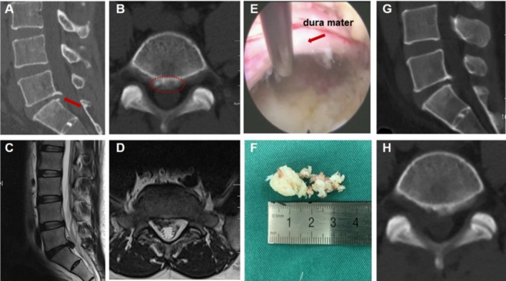 Sagittal Classification of Calcified Lumbar Disc Herniation and Therapeutic Analysis of Percutaneous Endoscopic Interlaminar Discectomy.
