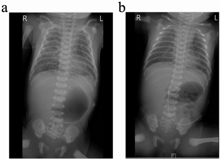 Neonatal early-onset sepsis caused by Streptococcus Gallolyticus subsp. Pasteurianus with severe pulmonary hypertension and leukemoid reaction: a case report.