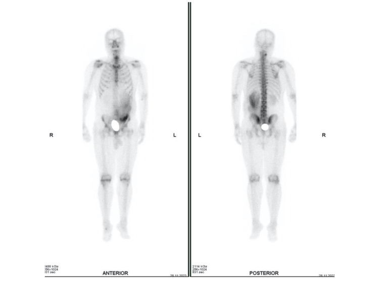 An Interesting Case of Fornix Rupture Discovered Accidentally on Bone Scintigraphy.