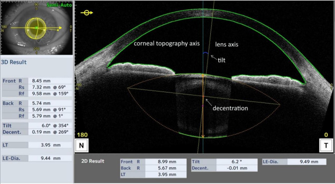 Lens tilt and decentration in a Chinese population with age-related cataracts and their influencing factors.